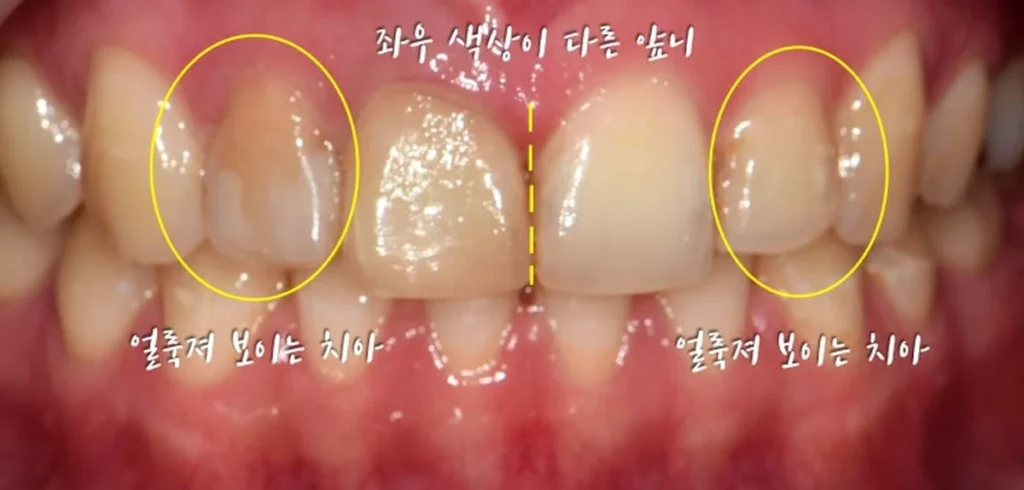 정중선 기준 좌우 색상이 다른 착색된 앞니 정면 구내 사진