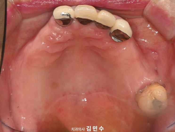 다수 치아 상실 환자의 초진 상악 구강 내 사진
