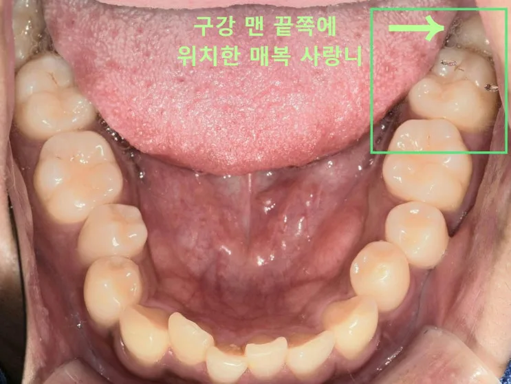 강동구 사랑니 발치 초진 구내사진, 왼쪽 아래 일부만 노출된 매복 사랑니