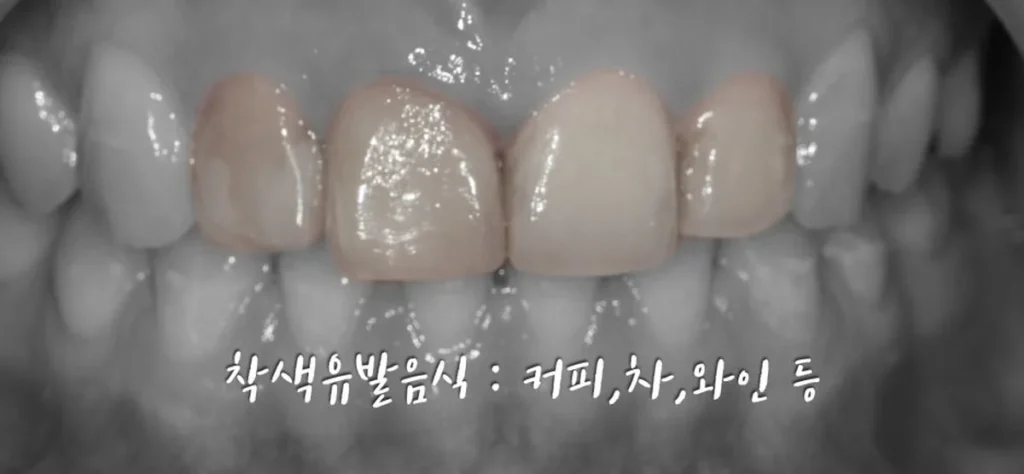 커피 차 와인 등 착색 유발 음식으로 변색된 앞니 레진 상태