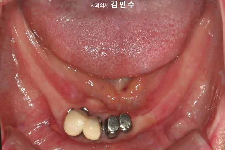 다수 치아 상실 환자의 초진 상악 구강 내 사진