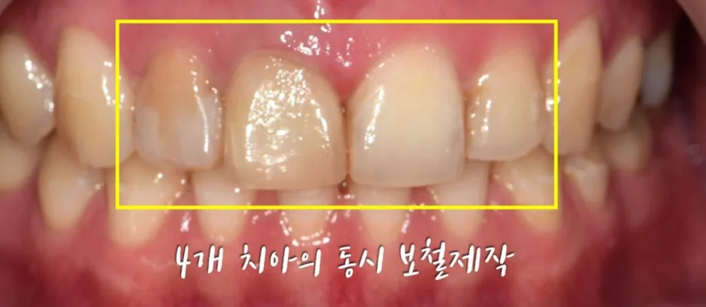 심미라인 앞니 4전치를 동시에 보철 수복하는 범위 표시 사진