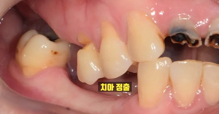 다수 상실로 인한 우측 어금니 치아 정출 구내 사진