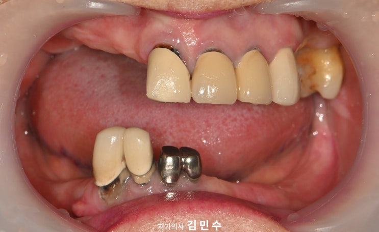 전악 임플란트 전 초진 전치부 교합 상태