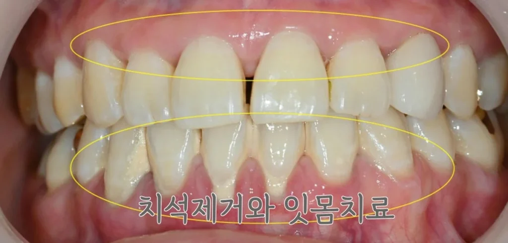 미네이트 전 스케일링과 잇몸치료로 치석을 제거하는 잇몸 관리 단계