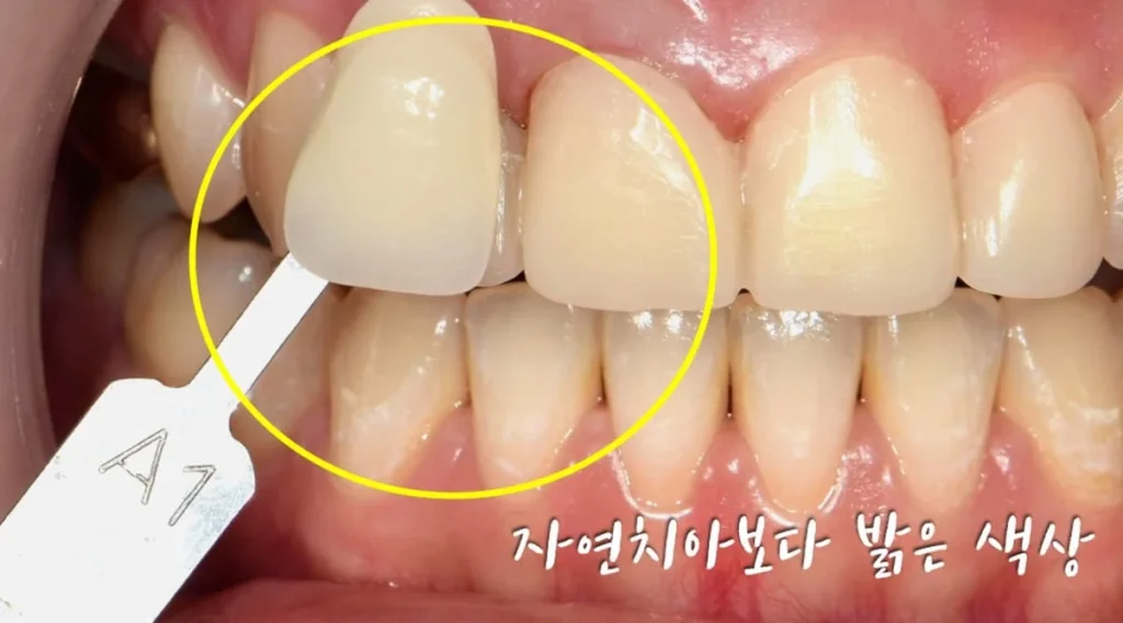 밝은 A1 셰이드 가이드를 앞니 옆에 대고 색상 비교하는 모습