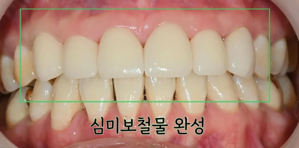 벌어진 앞니를 라미네이트로 개선해 공간을 메운 완성 정면 사진