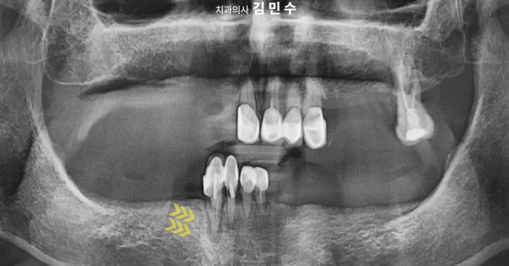 전악 임플란트 전 초진 파노라마 방사선 사진
