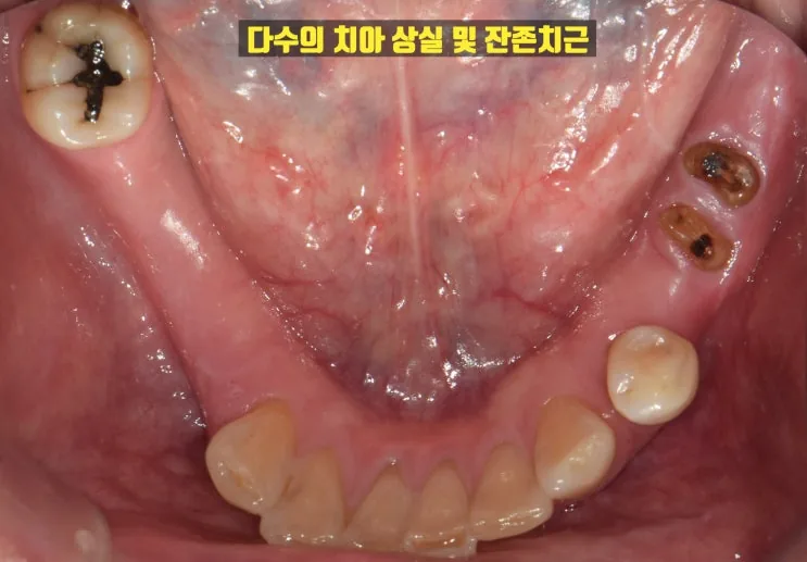 하악 치아 상실과 잔존 치근이 보이는 교합면 사진