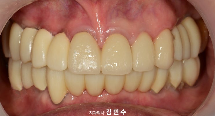 전악 임플란트 최종 보철 장착 후 정면 교합
