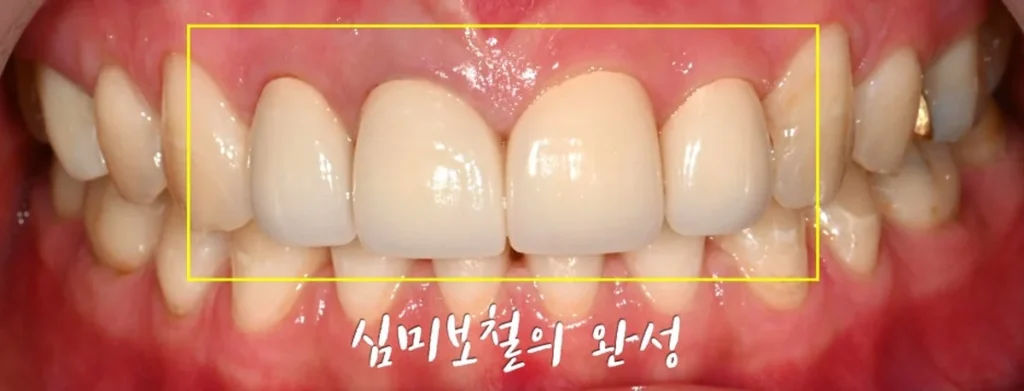 잇몸 라인과 매끄럽게 연결된 앞니 심미보철 완성 정면 사진