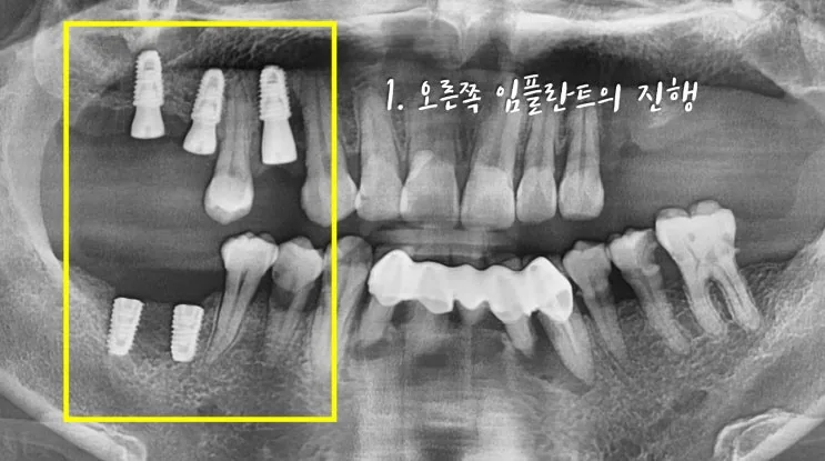 자연치와 유사한 오른쪽 지르코니아 보철 완성 구내 사진