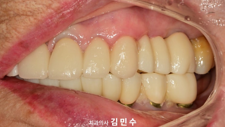 전악 임플란트 최종 보철 반대측 측면 교합