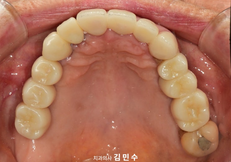 전악 임플란트 최종 보철 상악 교합면
