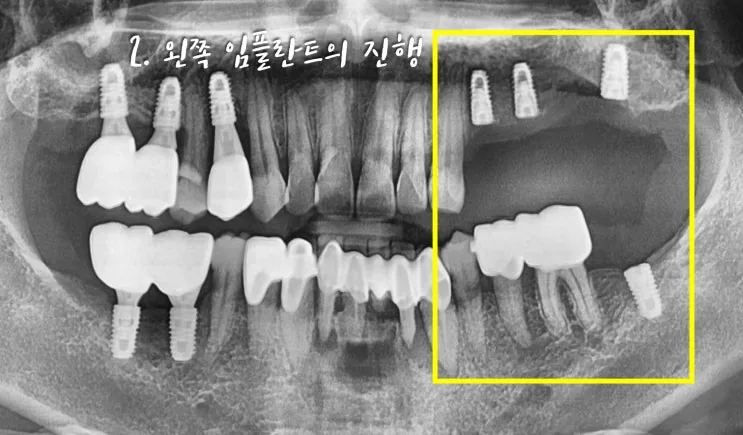 왼쪽 임플란트 식립이 진행된 파노라마