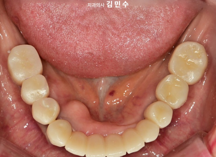 전악 임플란트 최종 보철 하악 교합면