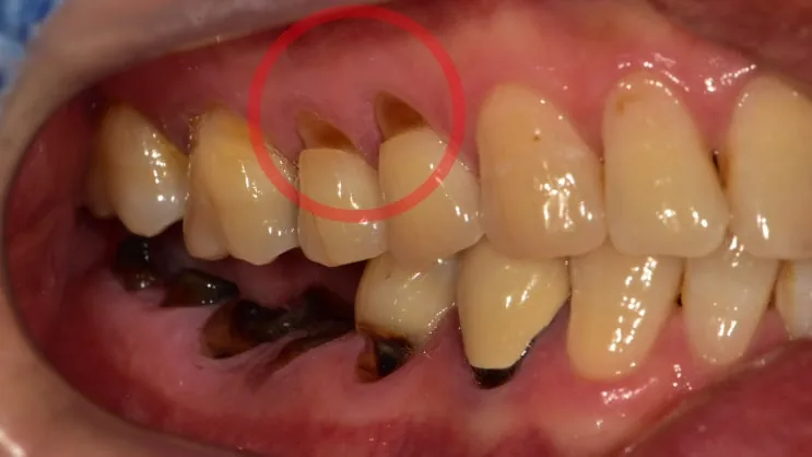 치료 전 좌측면 구강 내 사진