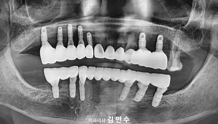 전악 임플란트 재건 완료 후 최종 파노라마 방사선 사진