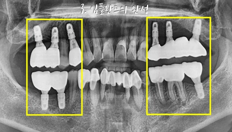 양측 임플란트 치료가 완성된 파노라마