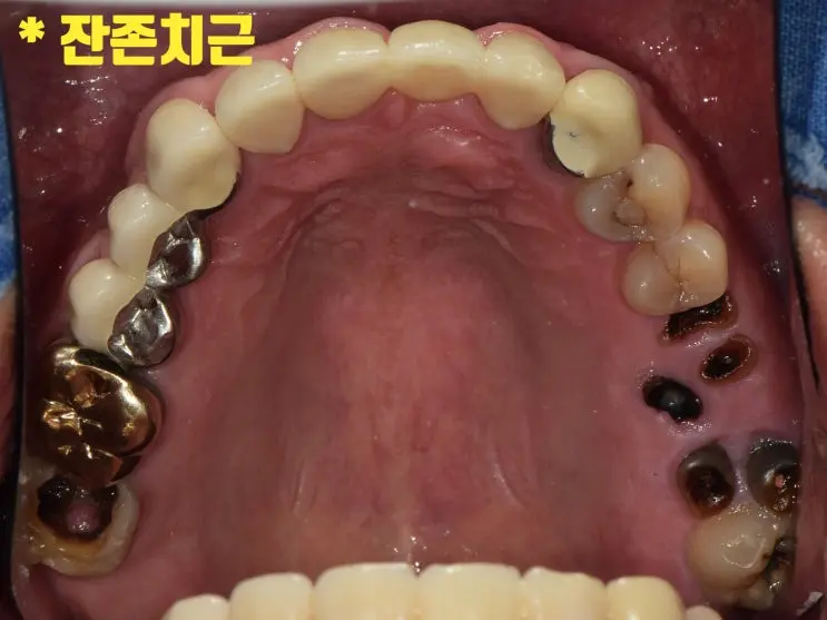 명일동 치과 상악동 거상술 임플란트 초진 상악 잔존 치근