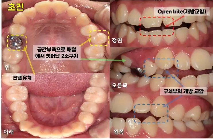 개방교합 구내사진