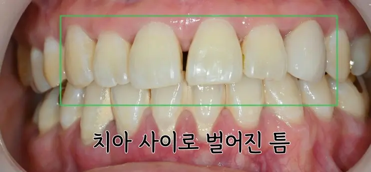 벌어진 앞니