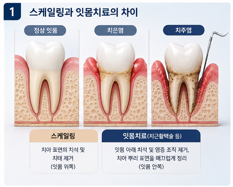 잇몸치료와 스케일링 차이