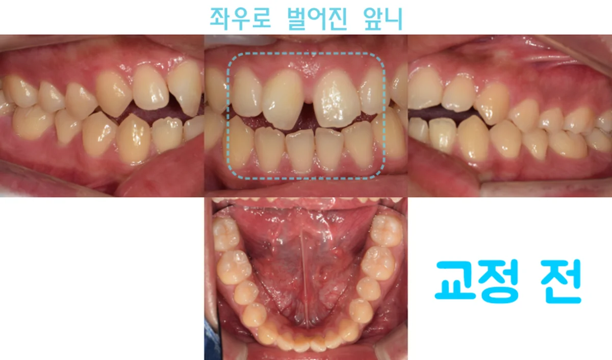 삐뚤어진 전치부 치열, 비발치 교정으로 개선한 사례 (강동구 치아교정)