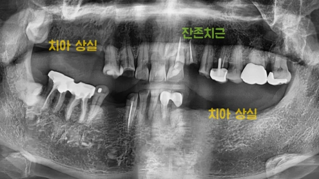 명일동 임플란트 파노라마 사진