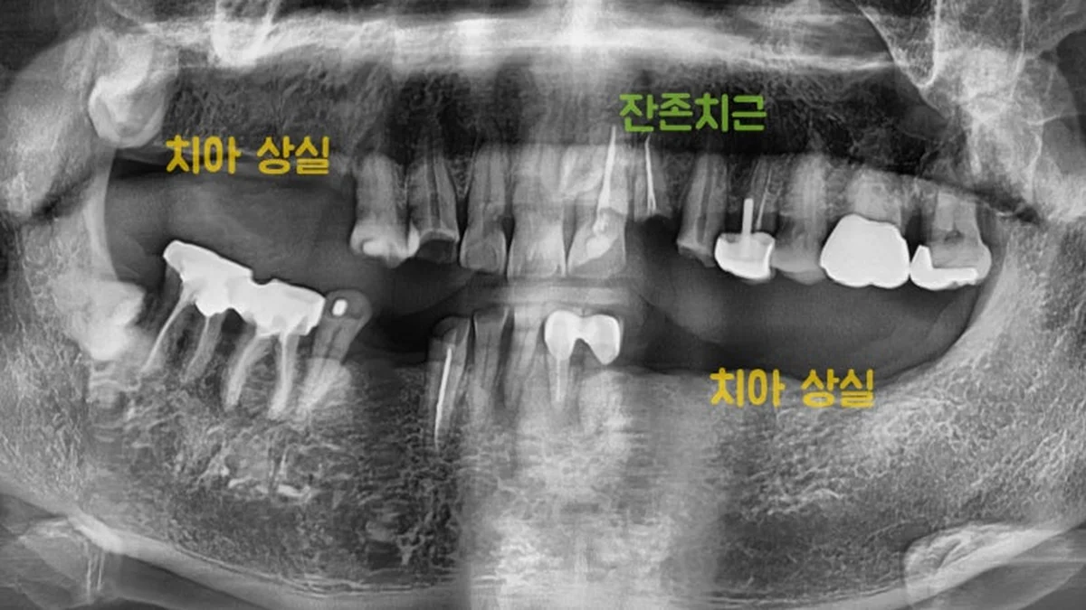 명일동 임플란트, 치아가 여러 개 상실됐을 때 어떻게 치료하나요 | 강동구 임플란트