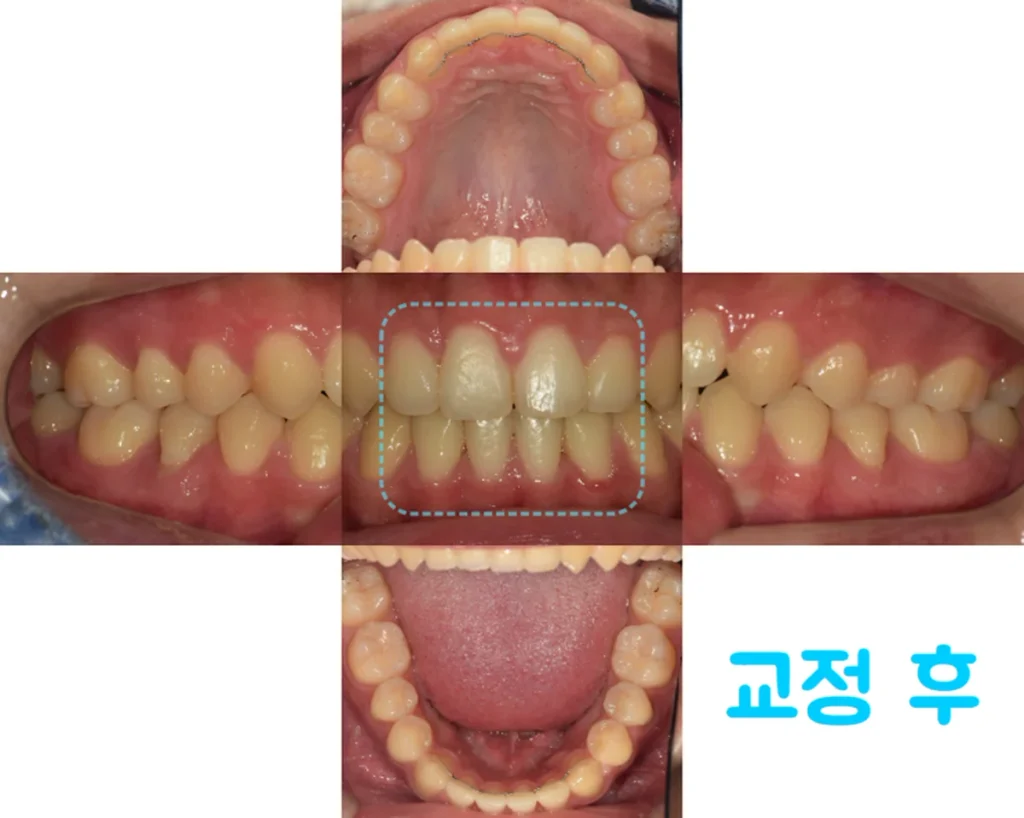 비발치 교정 후