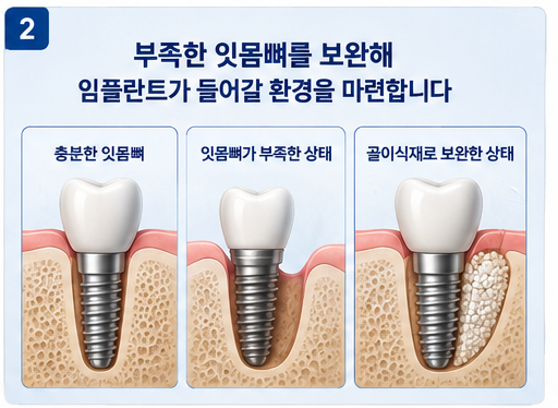 임플란트 뼈이식