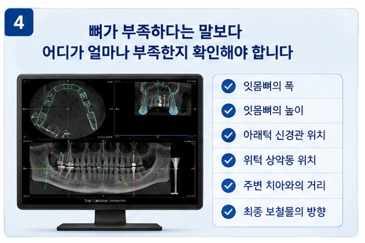 임플란트 뼈이식 CT 진단 확인 항목, 잇몸뼈 폭과 높이 신경관 상악동