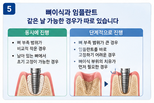 강동구 임플란트 뼈이식 동시 진행과 단계별 진행 비교