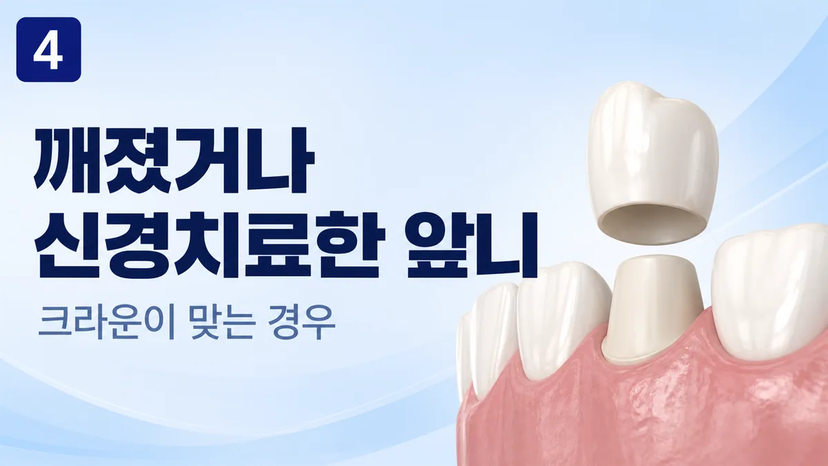 깨졌거나 신경치료한 앞니 — 크라운이 맞는 경우