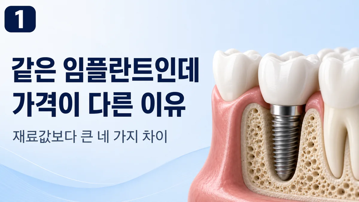같은 임플란트인데 가격이 다른 이유 — 재료값보다 큰 네 가지 차이