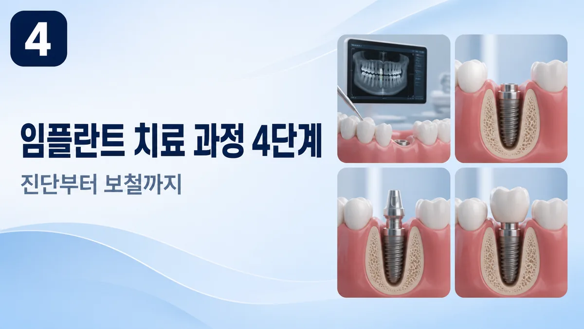 임플란트 치료 과정 4단계 — 진단부터 보철까지