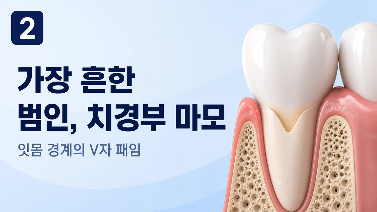 가장 흔한 원인인 치경부 마모, 잇몸 경계의 V자 패임