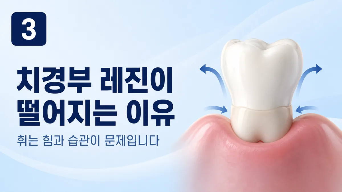 치경부 레진이 떨어지는 이유는 휘는 힘과 습관입니다