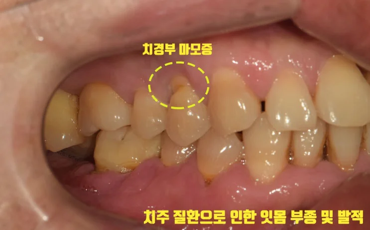 치주염으로 흔들리던 치아, 발치 후 골이식과 임플란트로 회복한 과정, 명일동 임플란트 치과에서 설명드립니다