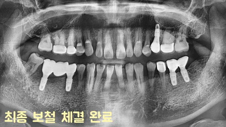수면 임플란트 완성