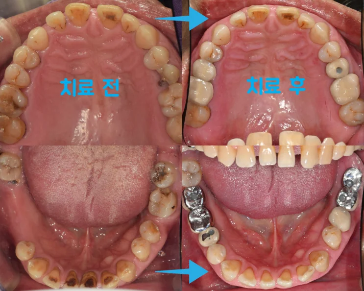 수면(의식하진정법) 임플란트란? 다수 치아 상실 사례로 설명드립니다 (강동구 임플란트치과)