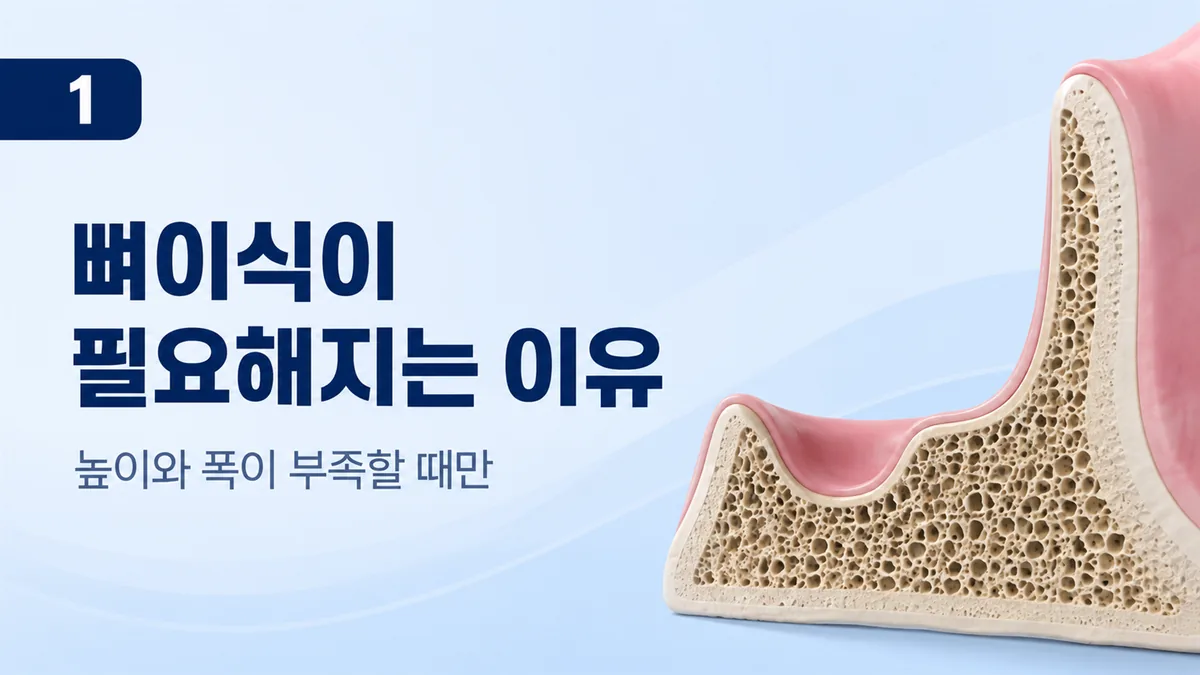 뼈이식이 필요해지는 이유, 잇몸뼈의 높이와 폭이 부족할 때
