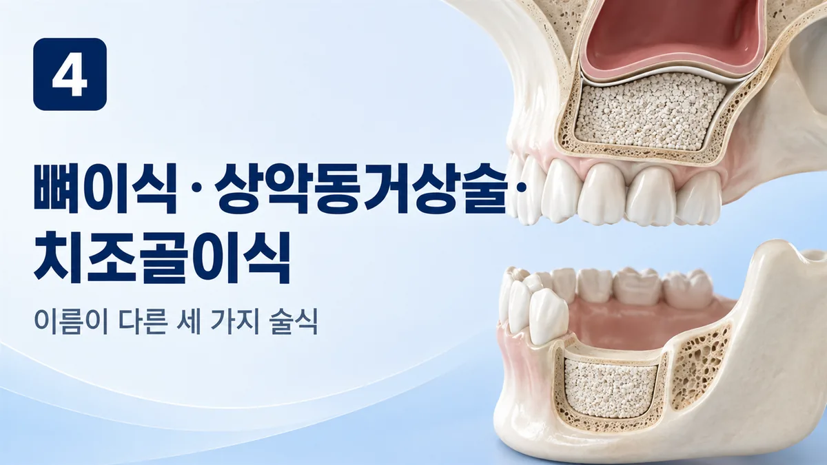 뼈이식·상악동거상술·치조골이식의 차이
