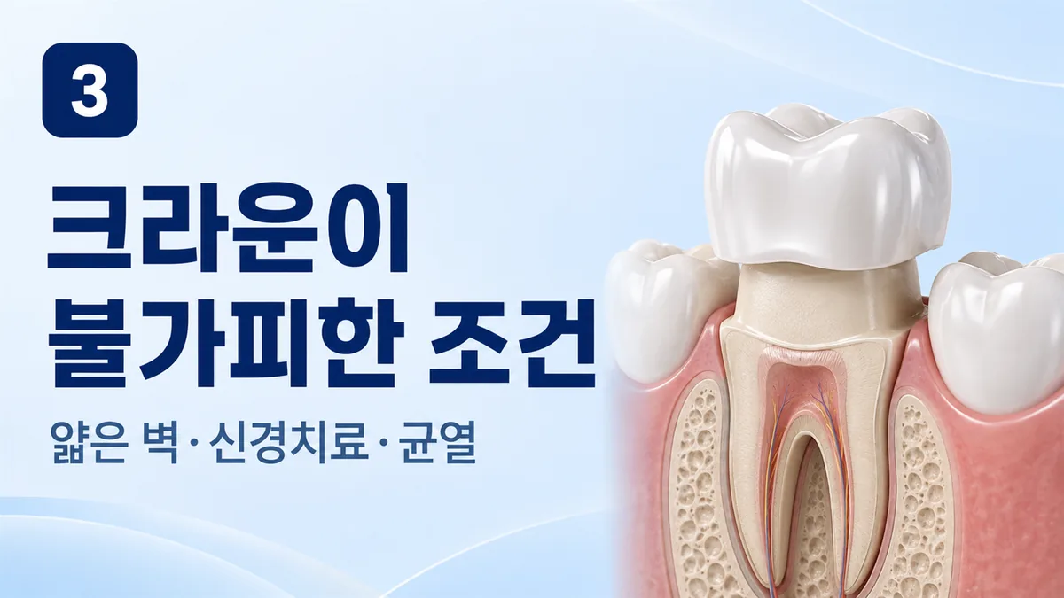 크라운이 불가피한 조건, 얇은 벽·신경치료·균열