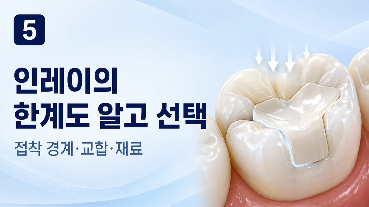 인레이의 한계, 접착 경계·교합·재료