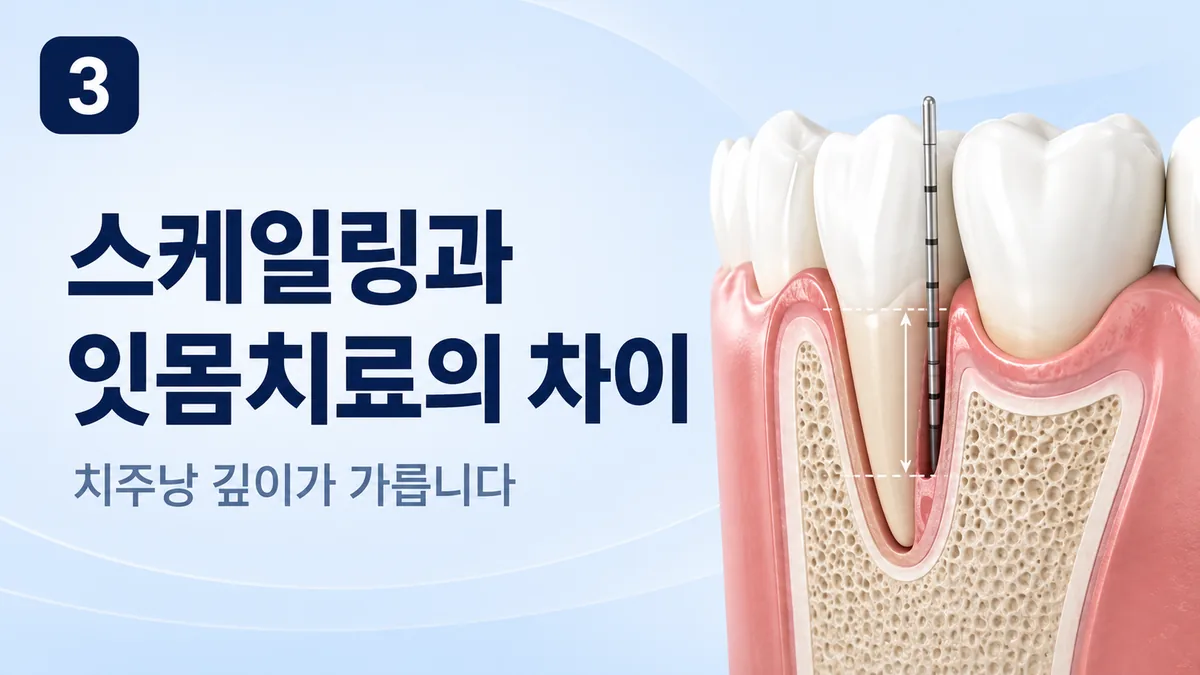 스케일링과 잇몸치료의 차이, 치주낭 깊이가 가릅니다