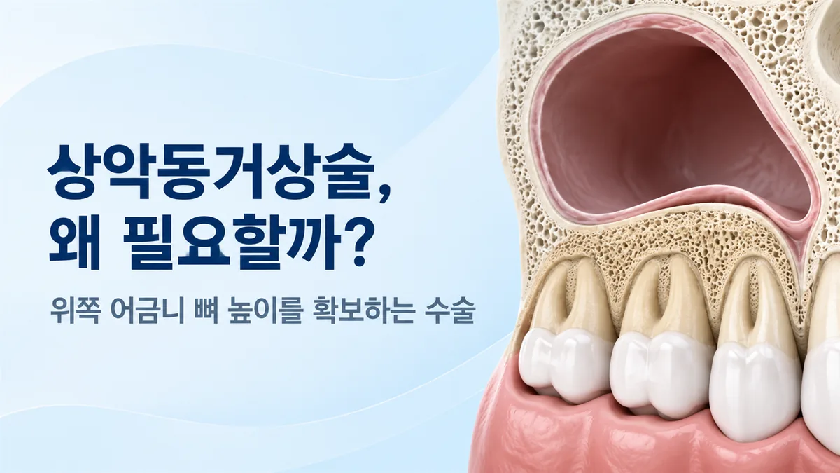 강동구 임플란트 상악동거상술 안내, 위쪽 어금니 뼈 높이를 확보하는 수술