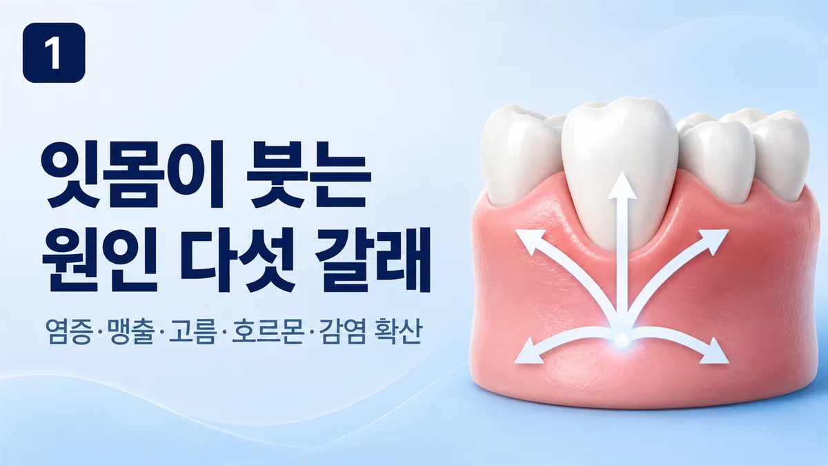 잇몸이 붓는 원인 다섯 갈래, 염증·맹출·고름·호르몬·감염 확산