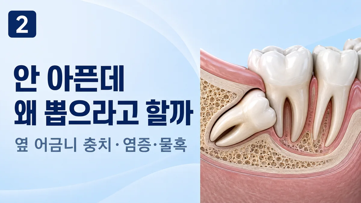 안 아픈 사랑니를 뽑으라고 하는 이유, 옆 어금니 충치·염증·물혹